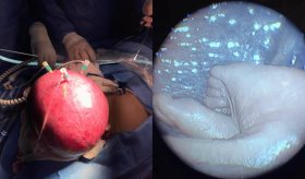 Colombia: Realizan exitosa cirugía intrauterina fetoscópica en gestante de 24 semanas