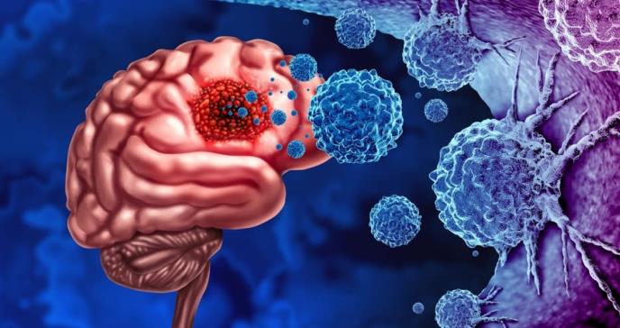El uso de vorasidenib podría detener la progresión de gliomas cerebrales malignos con mutación IDH
