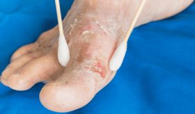 El papel crucial del control glucémico en el manejo del pie diabético