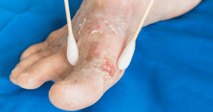 El papel crucial del control glucémico en el manejo del pie diabético