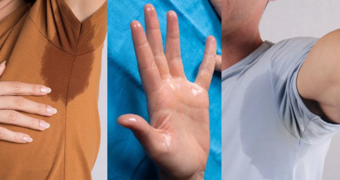 Hiperhidrosis: La condición médica detrás de la sudoración excesiva sin relación al calor o ejercicio