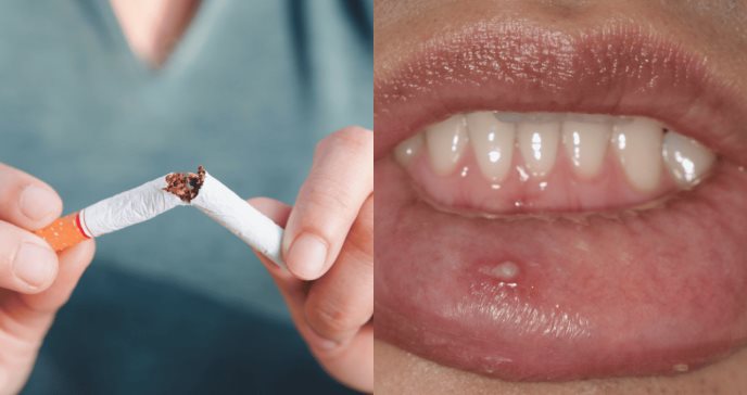 Interacción entre el humo del tabaco y el VPH predisponen a padecer cáncer de cabeza y cuello