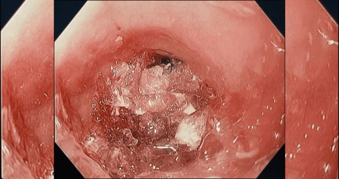 Mujer con esofagitis eosinofílica sufre atragantamiento al ingerir tres cápsulas de hidrogel