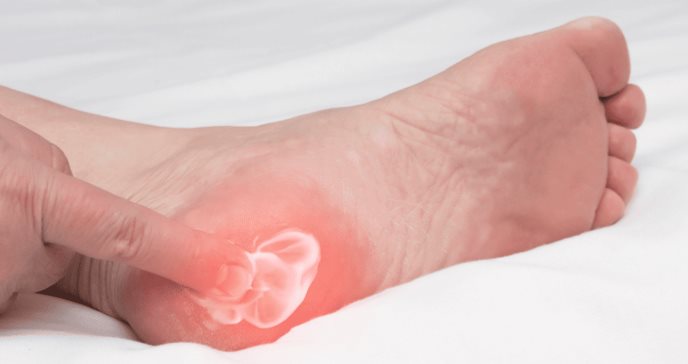 Dolor punzante en el pie: Identifique el espolón calcáneo y otros tipos de espolones en el talón