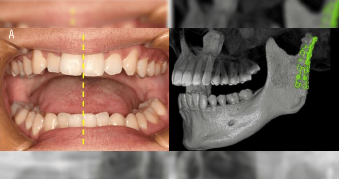 A la vanguardia: Tratan fractura de cóndilo mandibular con malla de titanio hecha a la medida y miniplaca