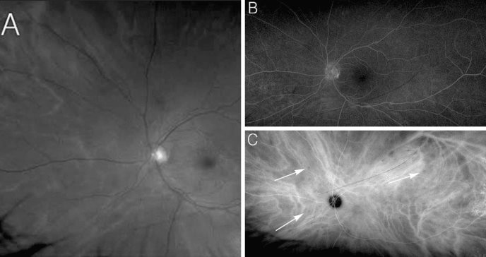 Pérdida gradual de visión en ojo izquierdo: atípica coriorretinopatía en perdigonada en mujer hispana