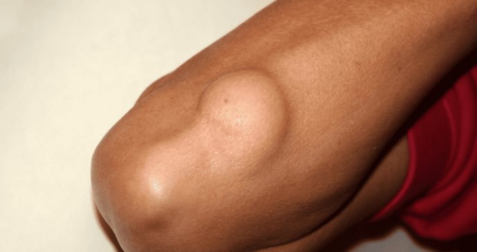 Liposarcoma: cáncer poco común de células grasas que provoca dolor abdominal y bultos debajo de la piel