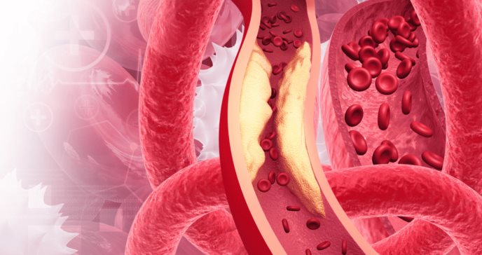 El endurecimiento de las arterias puede causar síndrome metabólico, revela estudio