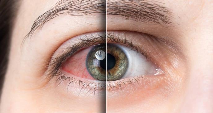 El síndrome de ojo seco afectaría al 85 % de pacientes con alteraciones del sueño, según estudio