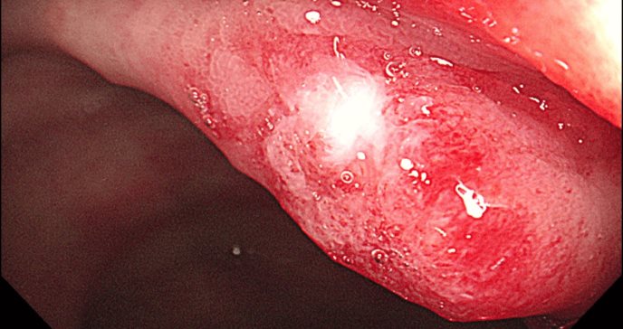 Paciente desarrolla úlceras rectales por uso inadecuado de inodoro bidé