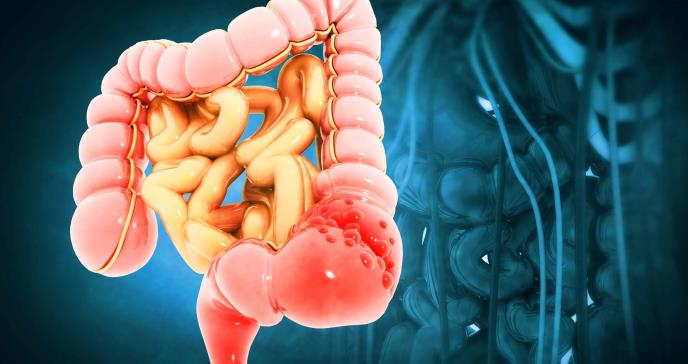 Anemia por deficiencia de hierro, sangrado rectal entre otros: Los nuevos síntomas del cáncer de colon