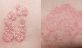 ¿Eczema o micosis? La diferencia entre ambas condiciones que afectan la piel
