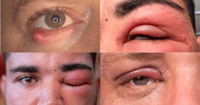 La celulitis que afecta el ojo: ¿Qué es y por qué se origina?