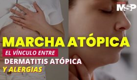 Marcha atópica: El vínculo entre dermatitis atópica y alergias