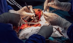 Hito médico: riñón de cerdo trasplantado ha funcionado durante un mes en un cuerpo humano