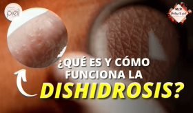 ¿Qué es y cómo funciona la dishidrosis? - #MSPDermatología