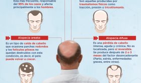 Tipos de alopecia | Infografía