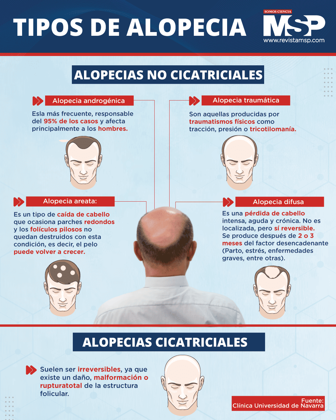 Tipos De Alopecia