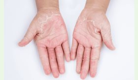 Jabones, detergentes y otros irritantes: ¿Qué causa la dermatitis de contacto?