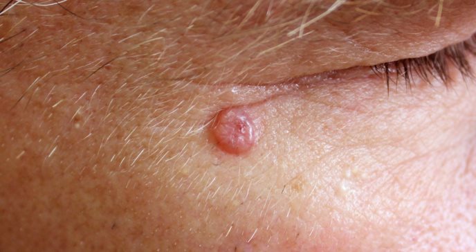 Masa roja en el rostro o cuello: así puede identificar el carcinoma de células de Merkel