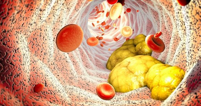 Partículas de glóbulos rojos podrían reducir la acumulación de grasa en las arterias