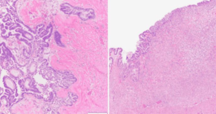 Tumor limítrofe seroso de ovario con nódulos murales de carcinoma anaplásico y afectación omental