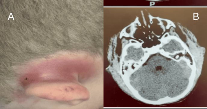 Paciente pediátrico presenta cefalea con hinchazón por raro hematoma subgaleal