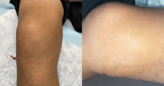 Dolor de rodilla por contusión culmina con diagnóstico de lesión de Morel-Lavallée en Puerto Rico