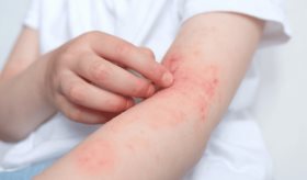 Dermatitis atópica: ¿Cómo la biotecnología ha transformado los tratamientos en la última década?