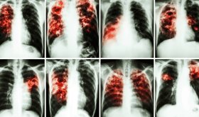 Publican nueva guía para manejo de enfermedad pulmonar intersticial en pacientes con enfermedad reumática