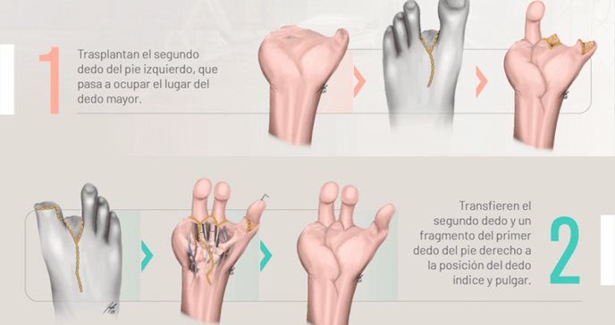 Especialistas reconstruyen mano de joven tras accidente utilizando los dedos de sus pies