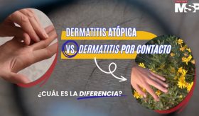 Dermatitis atópica vs. dermatitis por contacto: ¿Cuál es la diferencia?