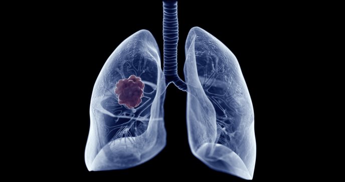 Cáncer de pulmón en mujeres, ¿existe una relación entre los factores hormonales y el aumento de casos?