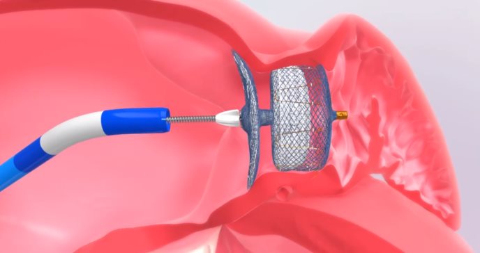 ¡Histórico! Centro Cardiovascular implanta nuevo dispositivo para tratar la fibrilación auricular