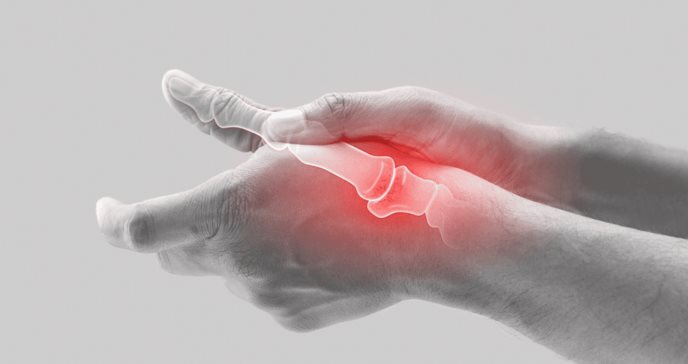 Artritis del pulgar y los síntomas claves que indican deterioro de la articulación carpometacarpiana