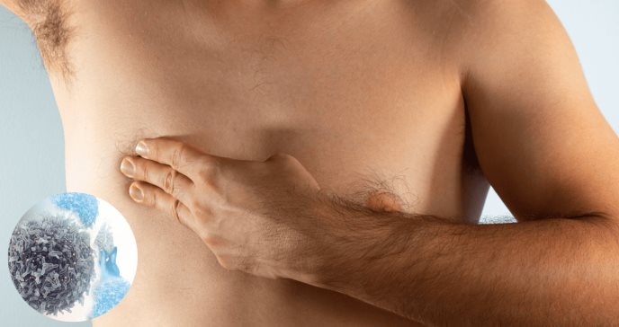 Cáncer de mama en hombres: alrededor del 80 % de diagnósticos se dan en etapas avanzadas