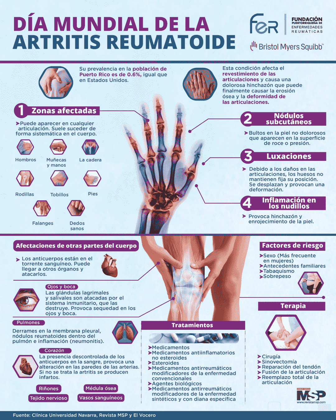 nódulos de artritis reumatoide en los dedos