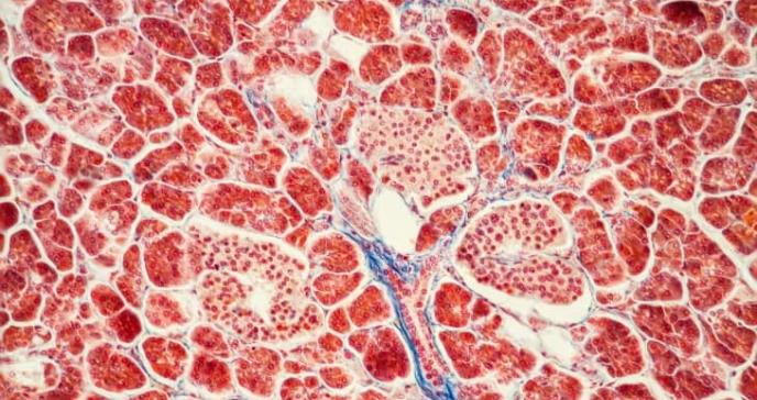 Anticuerpo teplizumab combate destrucción de células del páncreas en pacientes con diabetes tipo 1