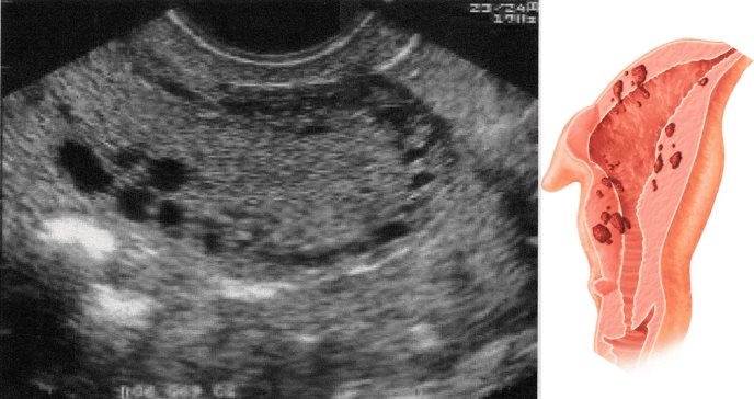 ¿Qué es la adenomiosis y por qué el sistema intrauterino liberador de levonorgestrel es eficaz?