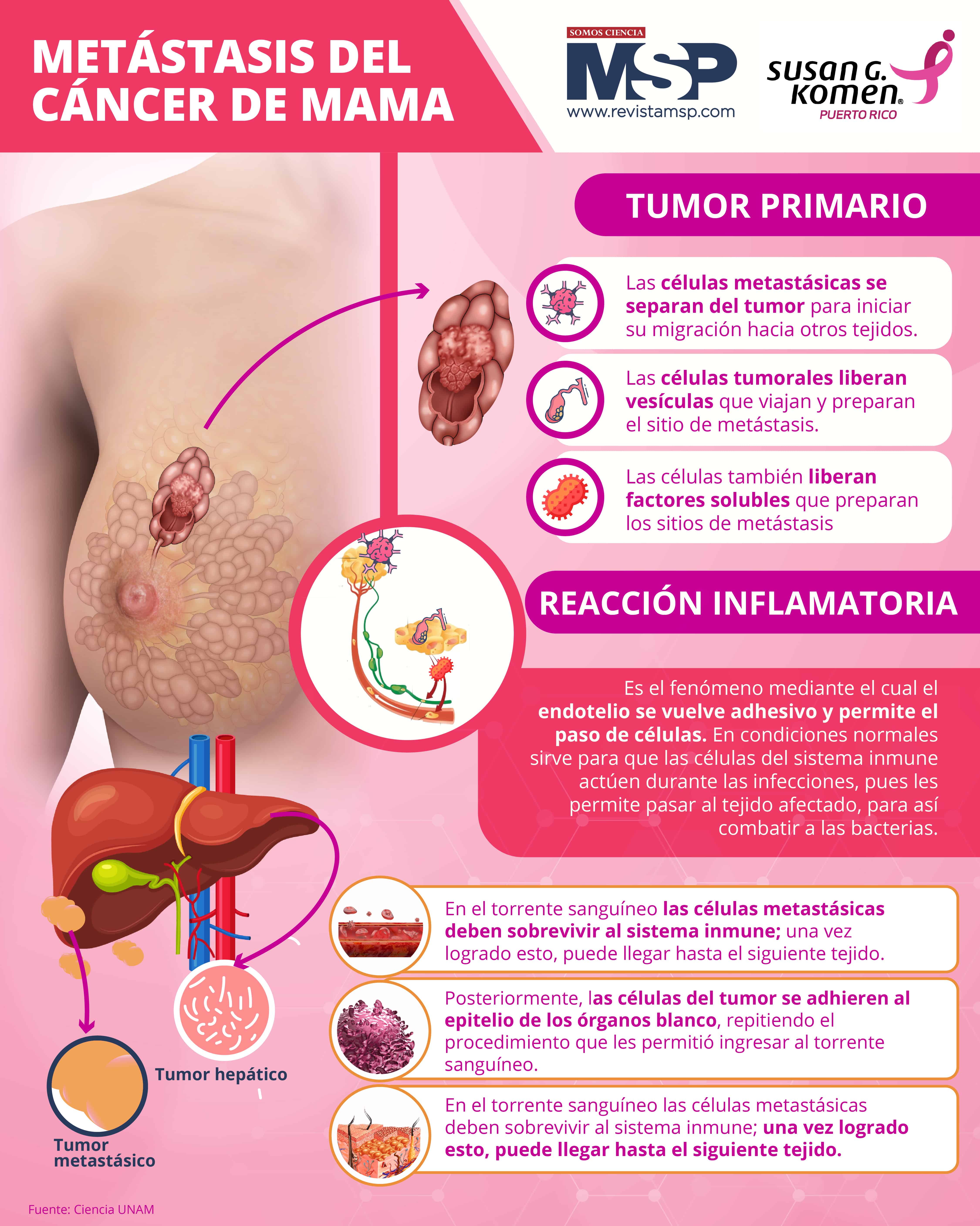 cancer de mama infografia