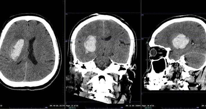 La muerte cerebral y muerte real: ¿Cuándo dejamos de vivir de verdad?