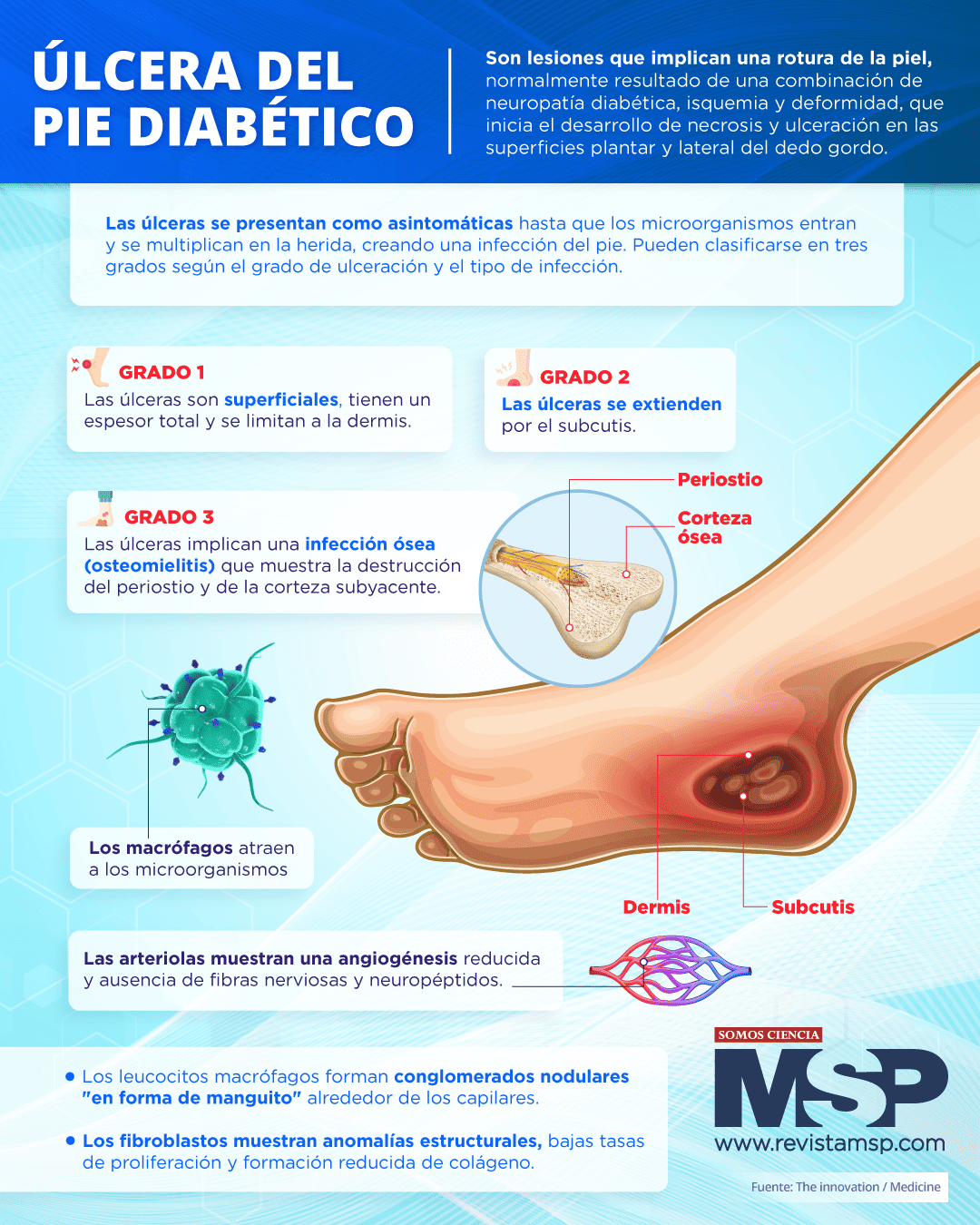 Úlceras En El Pie Diabético 5190