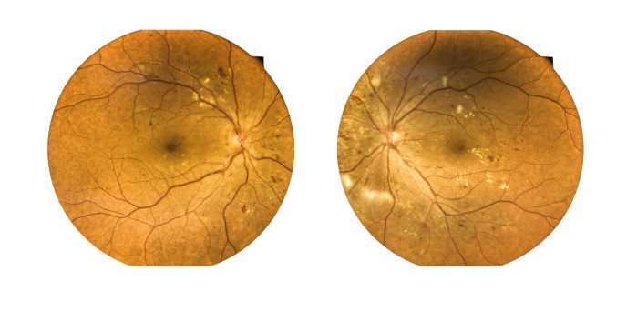 Hipertensión ocular: ¿Cuándo saber si edad, excesivo humor acuoso o drenaje inadecuado afecta los ojos?