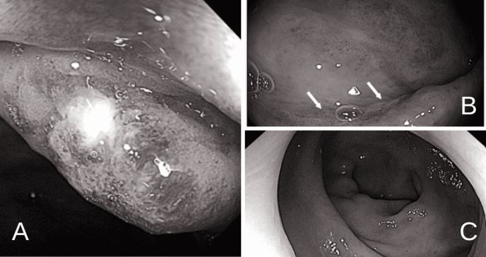 Paciente masculino presenta úlceras rectales tras lavado con inodoro o bidé eléctrico
