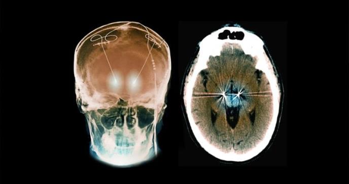 Implante cerebral personalizada frena síntomas de TOC en paciente con epilepsia