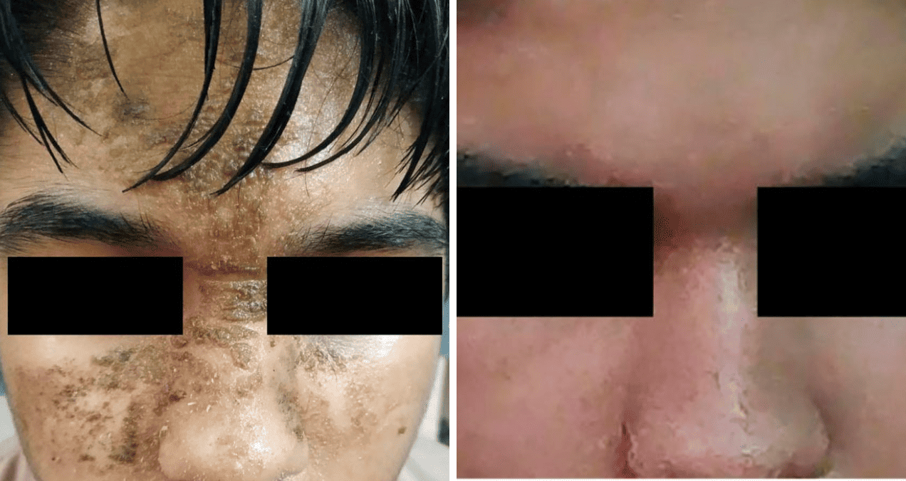Psicodermatología: Dermatitis neglecta como manifestación