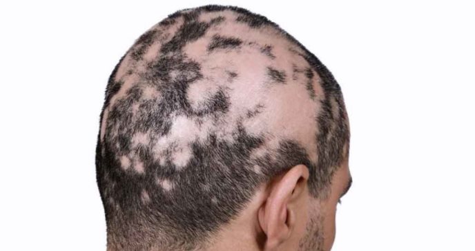 ¿Qué es la alopecia universal y por qué solo el 10 % de pacientes se recupera completamente?
