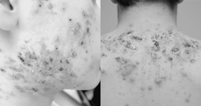 Paciente con úlceras es diagnosticado con acné fulminans tras infección de coronavirus y pulmonía