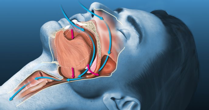 Relación de la apnea del sueño con el envejecimiento por acumulación de tejido graso en cuello y lengua