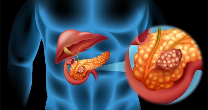 Niveles altos de insulina asociados con mayor riesgo de cáncer pancreático
